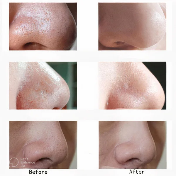 Electric Blackhead Remover Vacuum Pore Cleaner Electric blackhead remover vacuum pore cleaner for deep skin cleansing